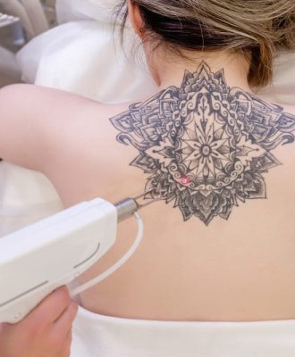 Tatoo Remove